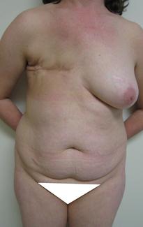 Preop  less_cropped_and_painted.jpg