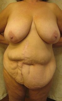 Preop less_cropped.jpg