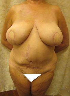 DIEP and SIEA Flaps cropped_and_painted.jpg