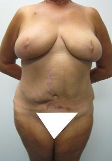 Post nipple recon and reduction cropped_and_painted.jpg