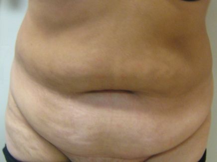 Before abdominoplasty