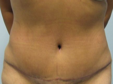 After abdominoplasty